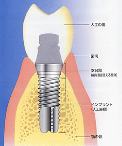 インプラントの構造