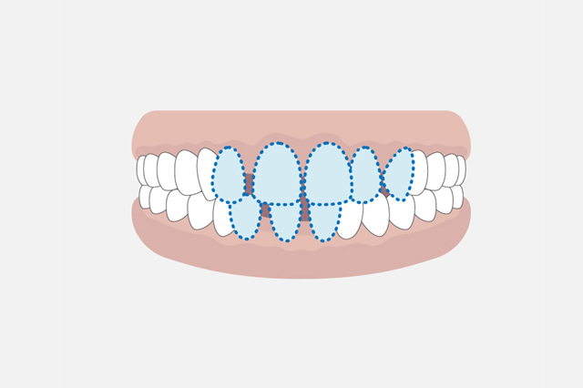 よくある歯列不正の歯並びの種類