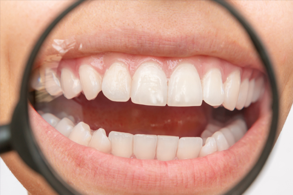 インプラント周囲炎について